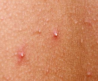 10 عادت مراقبت از پوست که میتواند آکنه را بدتر کند